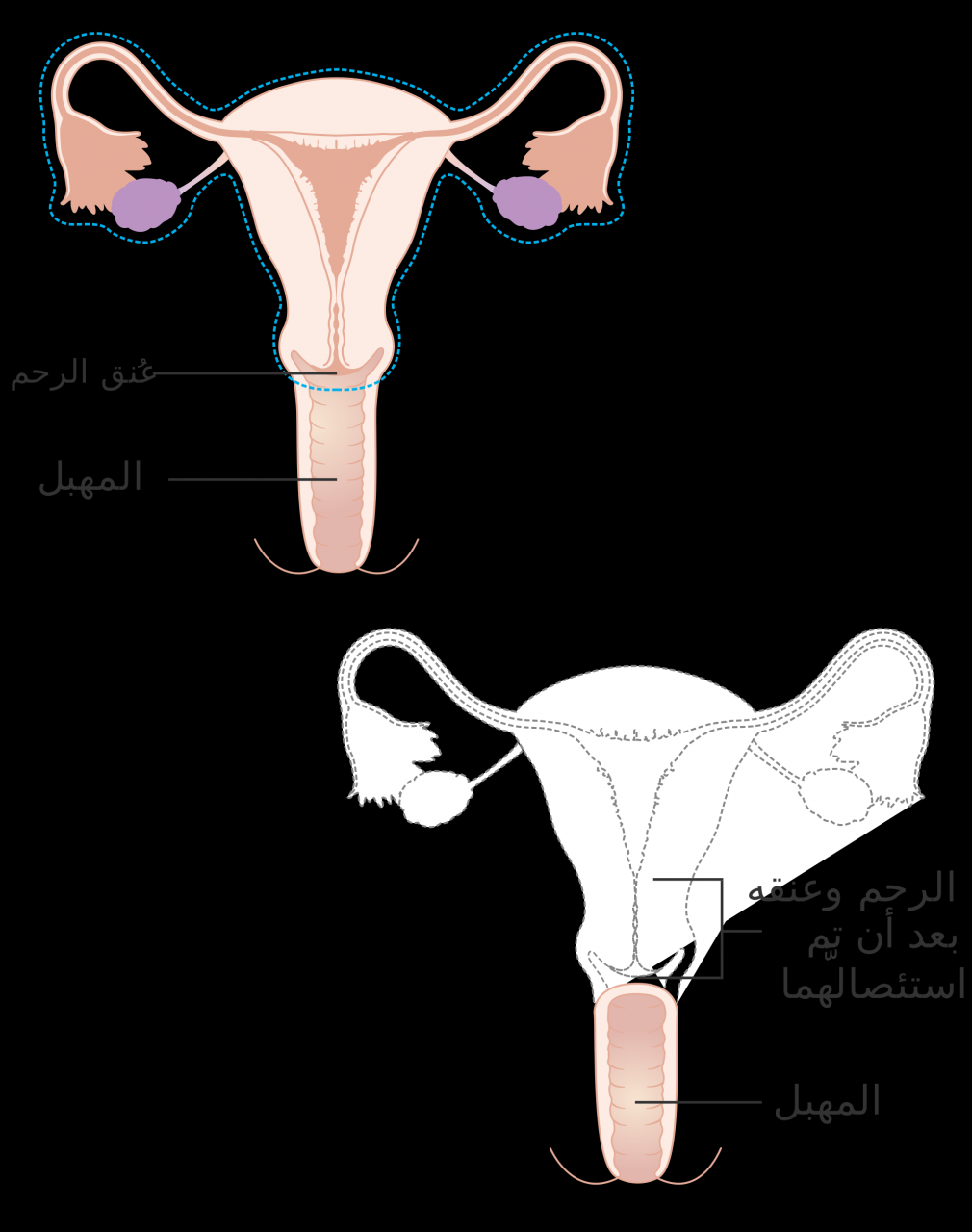 هل سرطان الرحم خطير , تعالي اعرف سرطان الرحم الخطير ام لا