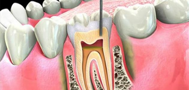 علاج عصب الاسنان , التخلص من وجع عصب الاسنان