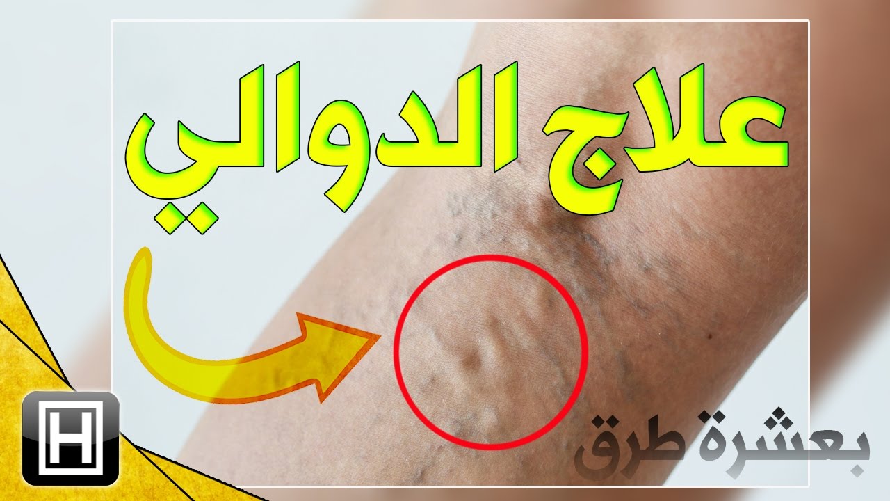 علاج الدوالى بالاعشاب - اسهل طريقه لعلاج الدوالى 1702 3