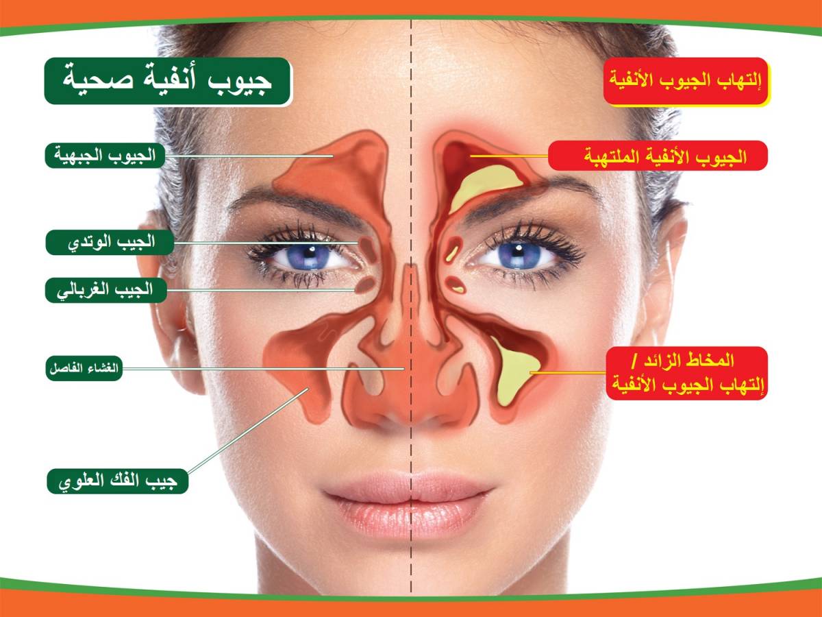 ماهو علاج الجيوب الانفيه - طريقه علاج الجيوب الانفيه 1559