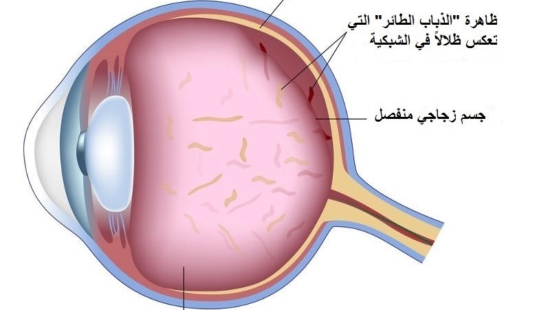 رؤية وميض في طرف العين , ظاهرة الذبابة الطائرة اسبابها وعلاجها