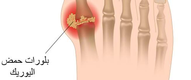 اعراض النقرس واسبابه - ارشادات يجب معرفتها لو انت مريض بالنقرس 186 2