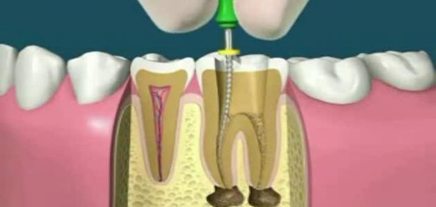 علاج عصب الاسنان - التخلص من وجع عصب الاسنان 1079 1