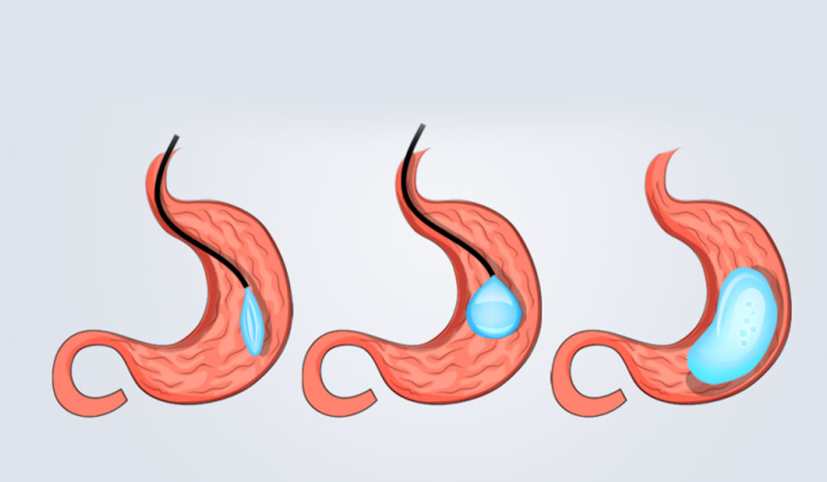 عملية بالون المعدة , معلومات مهمه قبل اجراء هذه العمليه