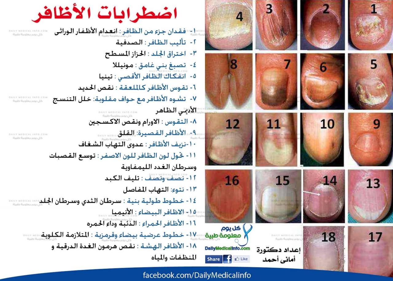 اسباب تعرج الاظافر , علاج تعرج الاظافر بسهوله