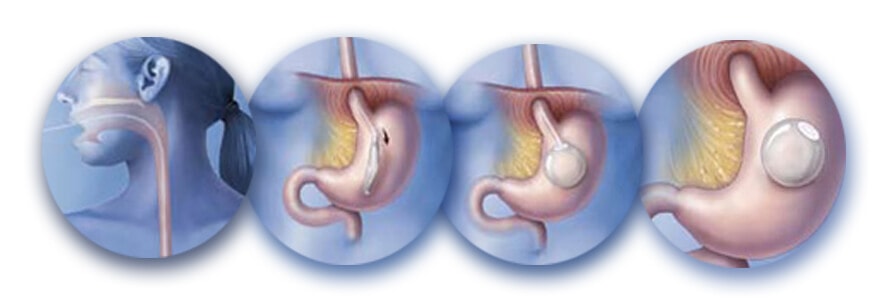 عمليه بالون المعده - ما هى عملية بالون المعده وتكلفتها 286 3