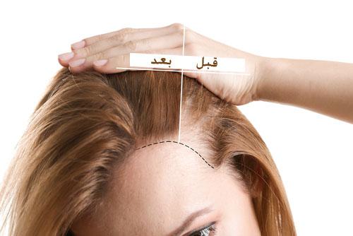 زراعة الشعر في السعودية - لجمال شعرك اختارى الافضل لكى 121 4