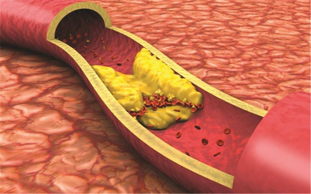 اعراض زيادة الكوليسترول والدهون الثلاثية , اعانى من زيادة الكوليسترول فى الدم