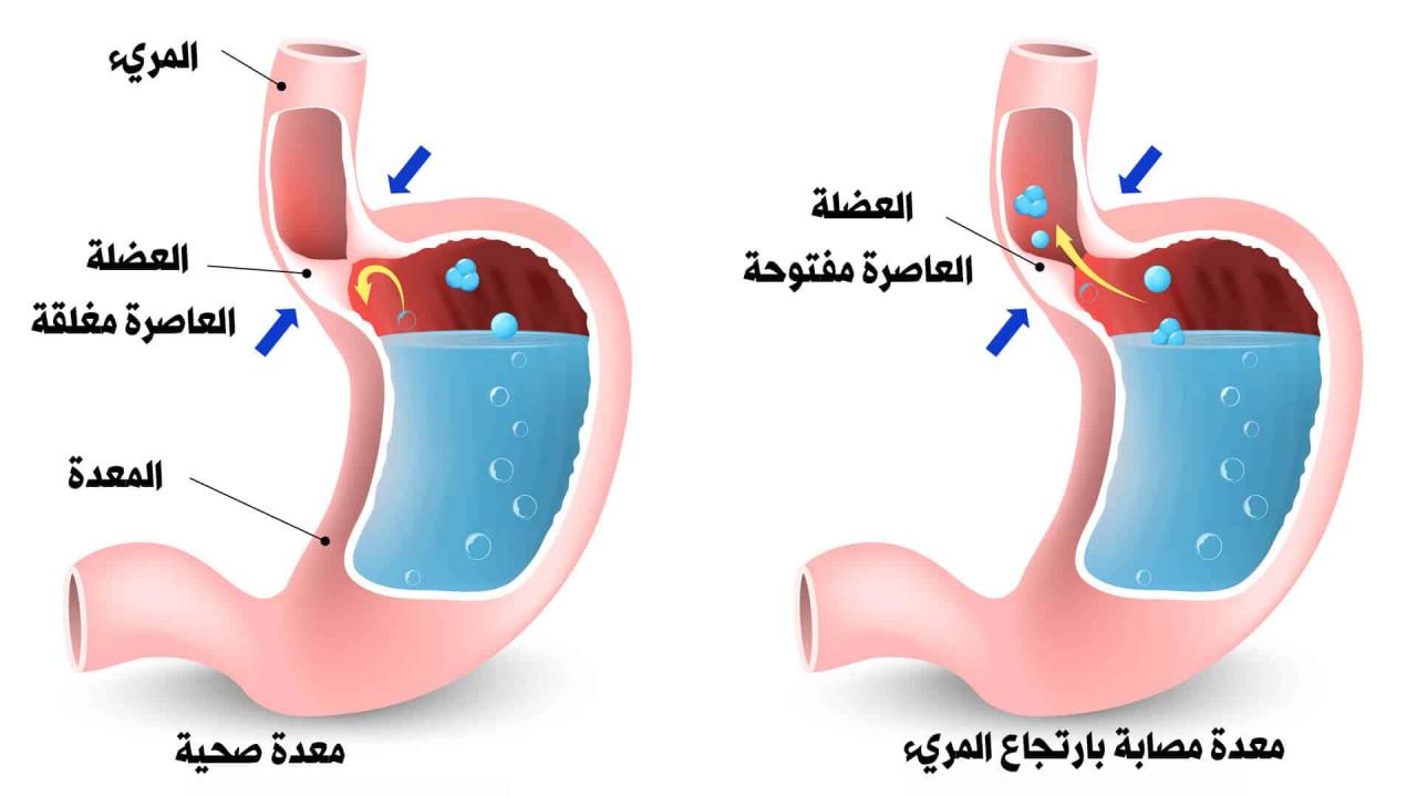 علاج ارتجاع المرئ - اسهل طريقه لعلاج ارتجاع المرئ في اسبوع واحد 1851 2