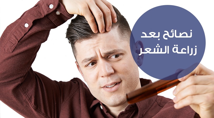 القشرة بعد زراعة الشعر - التخلص من القشور بطرق طبيعية 3294 3