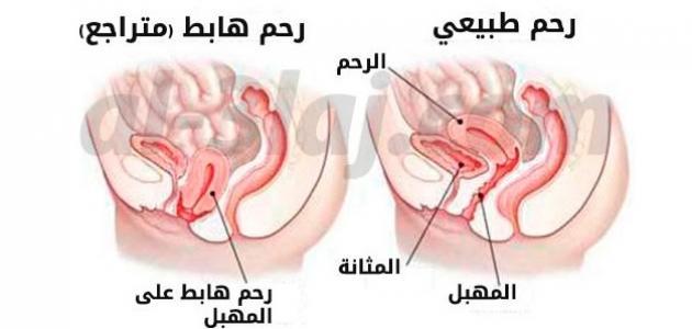 اسباب نزول الرحم 3706