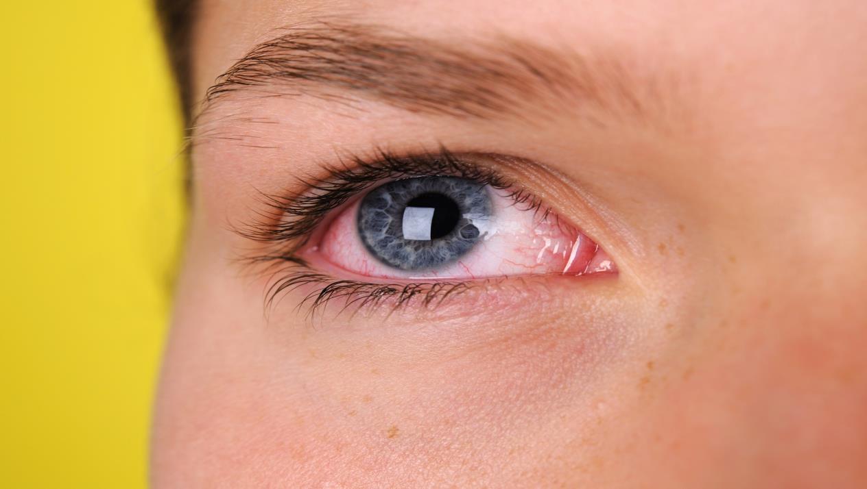علاج التهاب العين , التهابات العيون وعلاجها - افخم فخمه