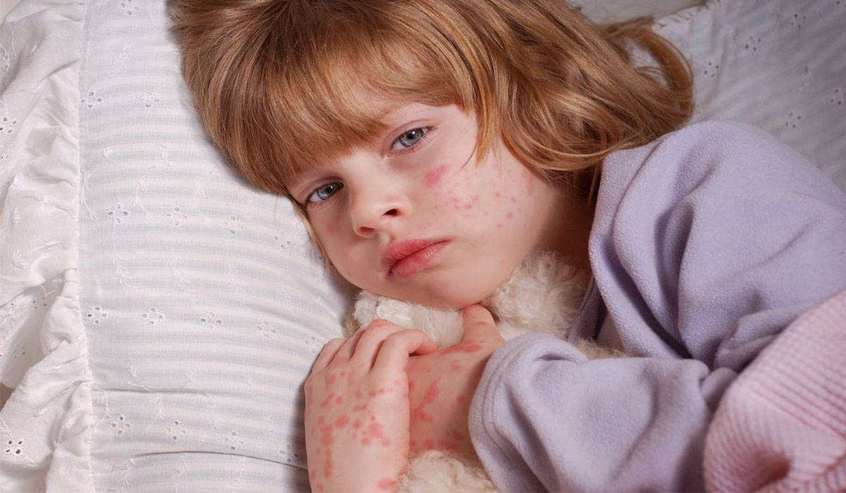 علاج الحساسية الجلدية عند الاطفال , علاج الحساسيه للاطفال في يومان فقط ...